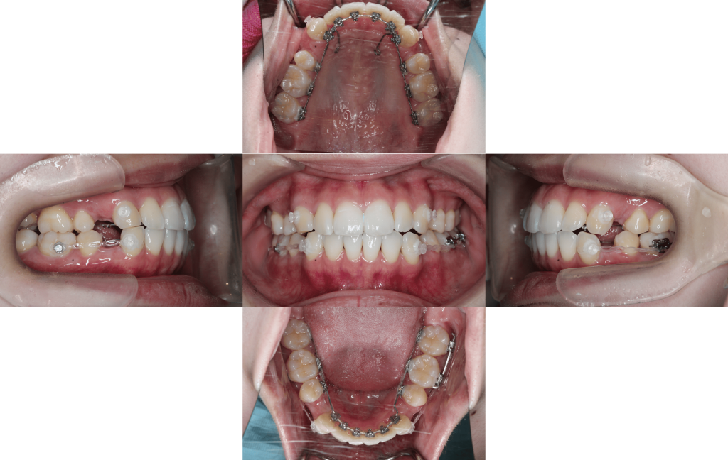 裏側矯正　上下顎前突症例