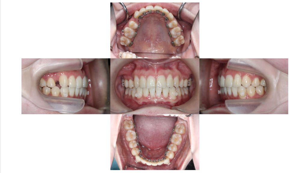叢生・コンビネーション矯正の症例