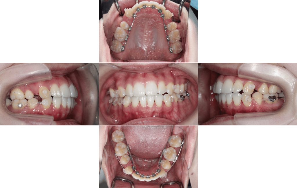 裏側矯正　上下顎前突症例