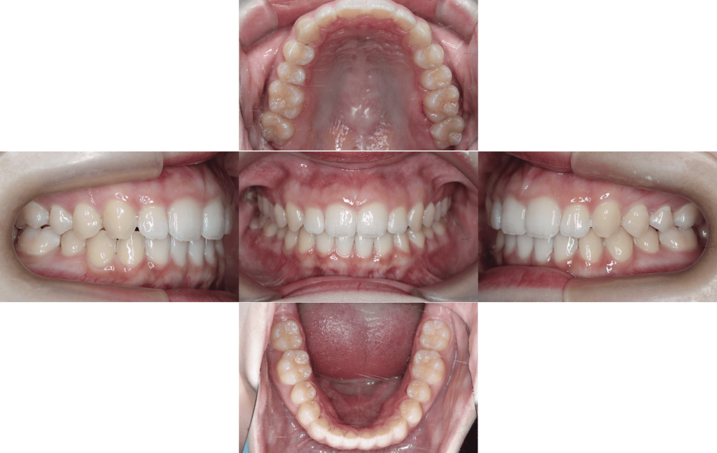 裏側矯正　正中離開症例