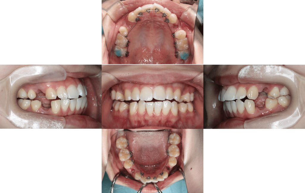 裏側矯正　上下顎前突症例