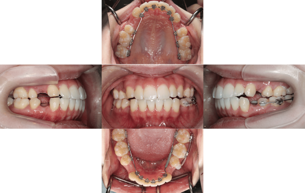 裏側矯正　上下顎前突症例