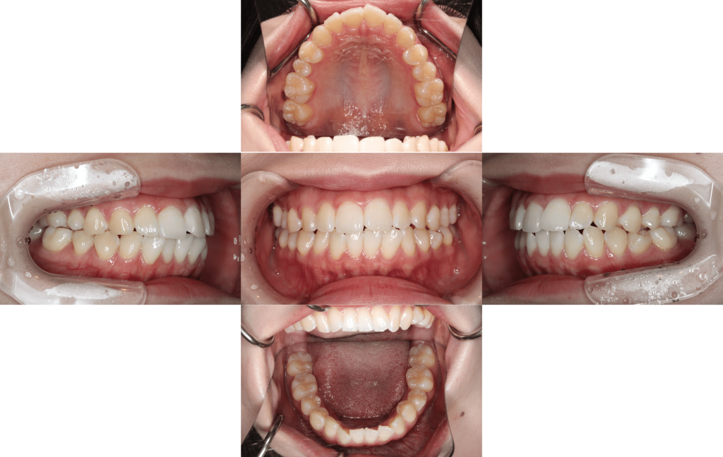 裏側矯正　上下顎前突症例