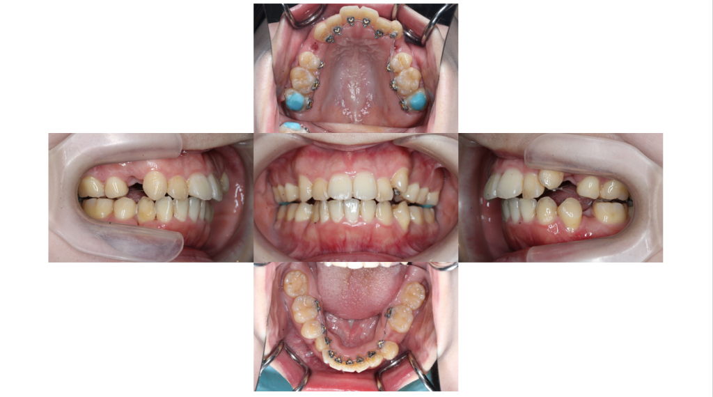 叢生・裏側矯正の症例