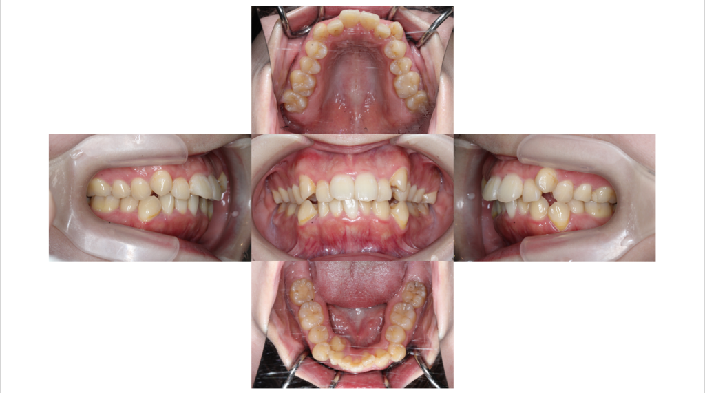 叢生・裏側矯正の症例