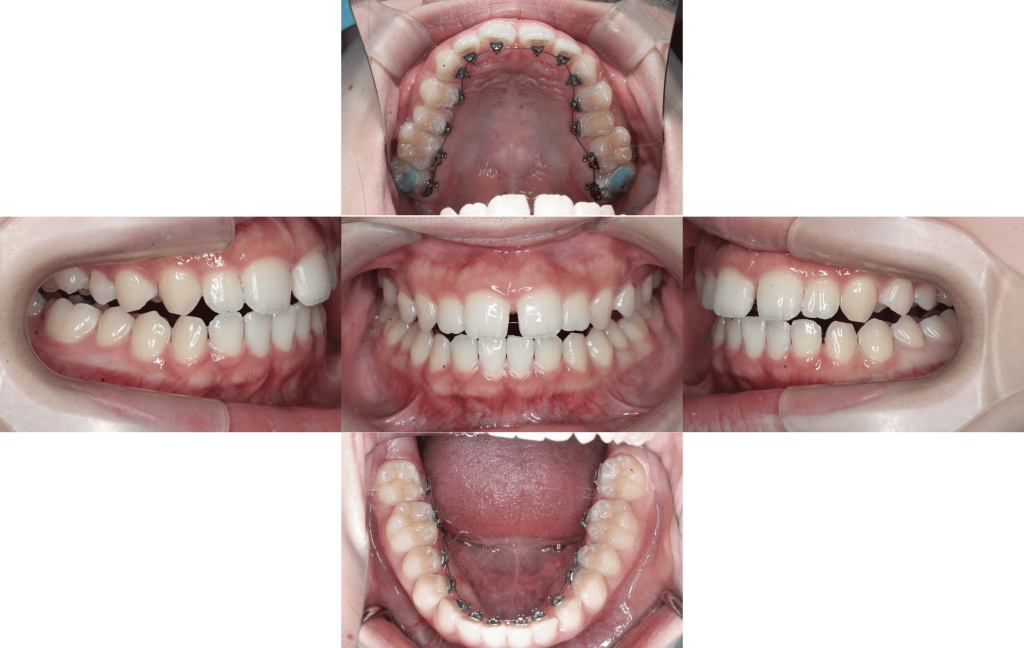 裏側矯正　正中離開症例
