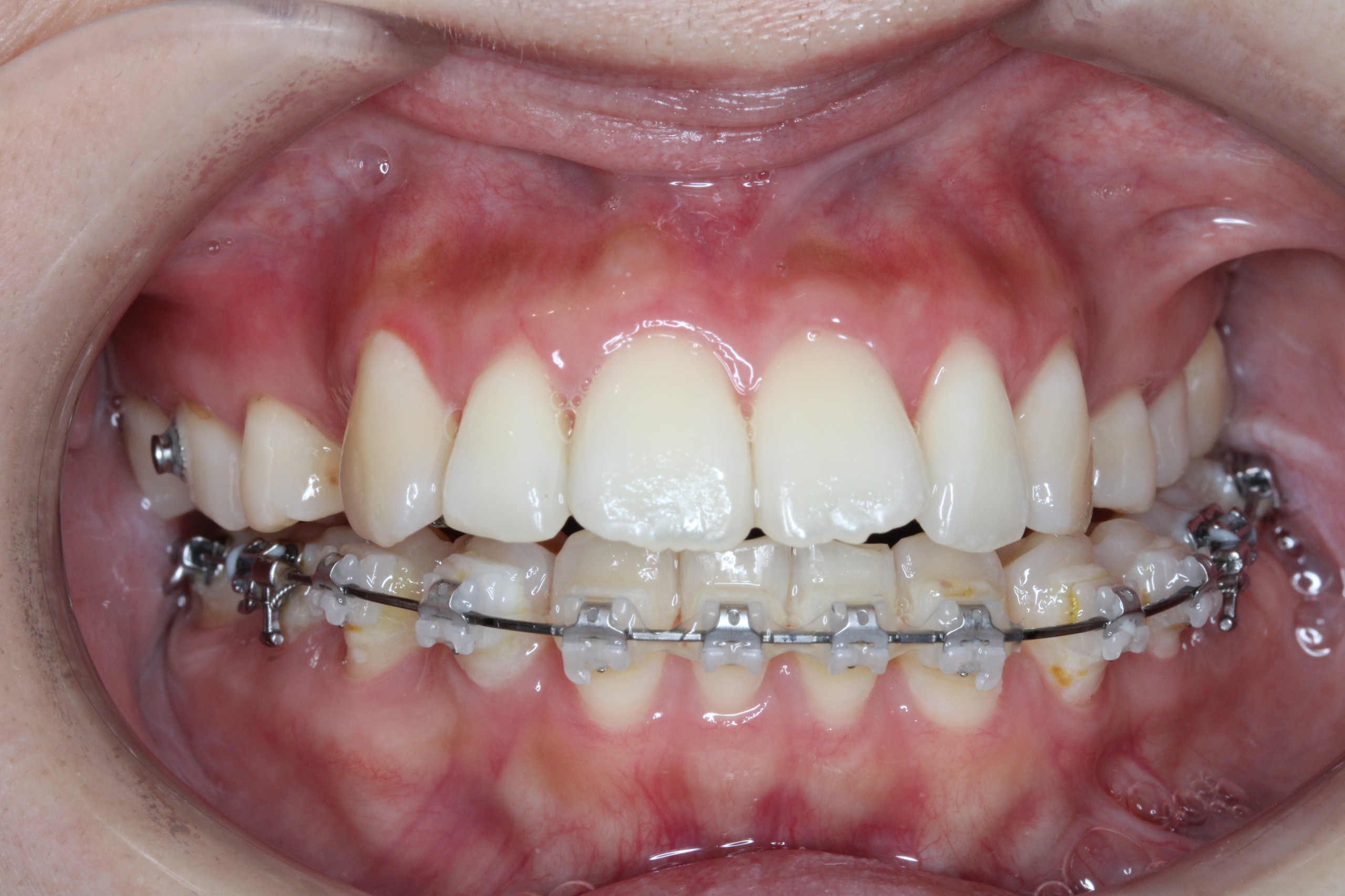 叢生・ハーフリンガルの症例