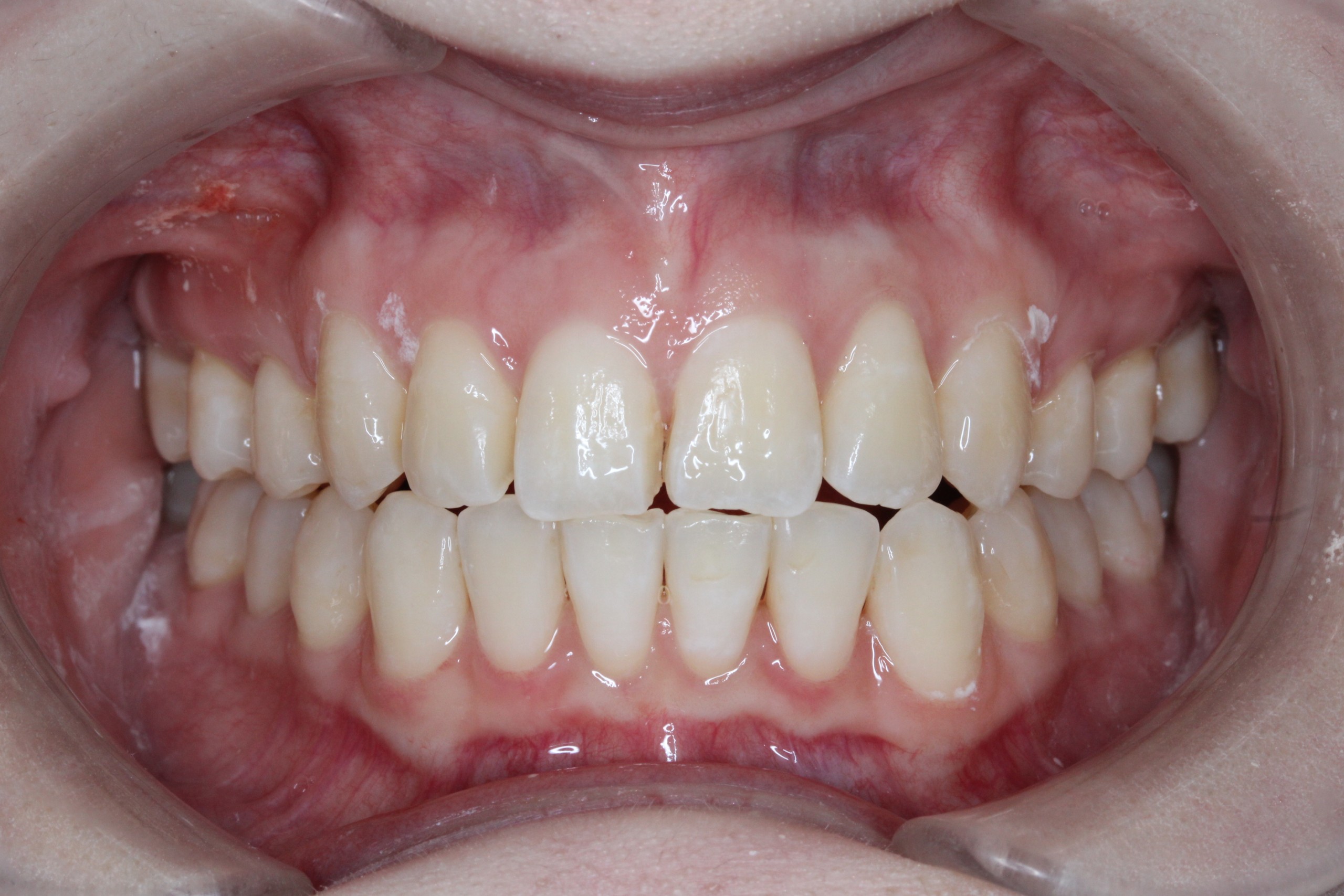 叢生・コンビネーション矯正の症例