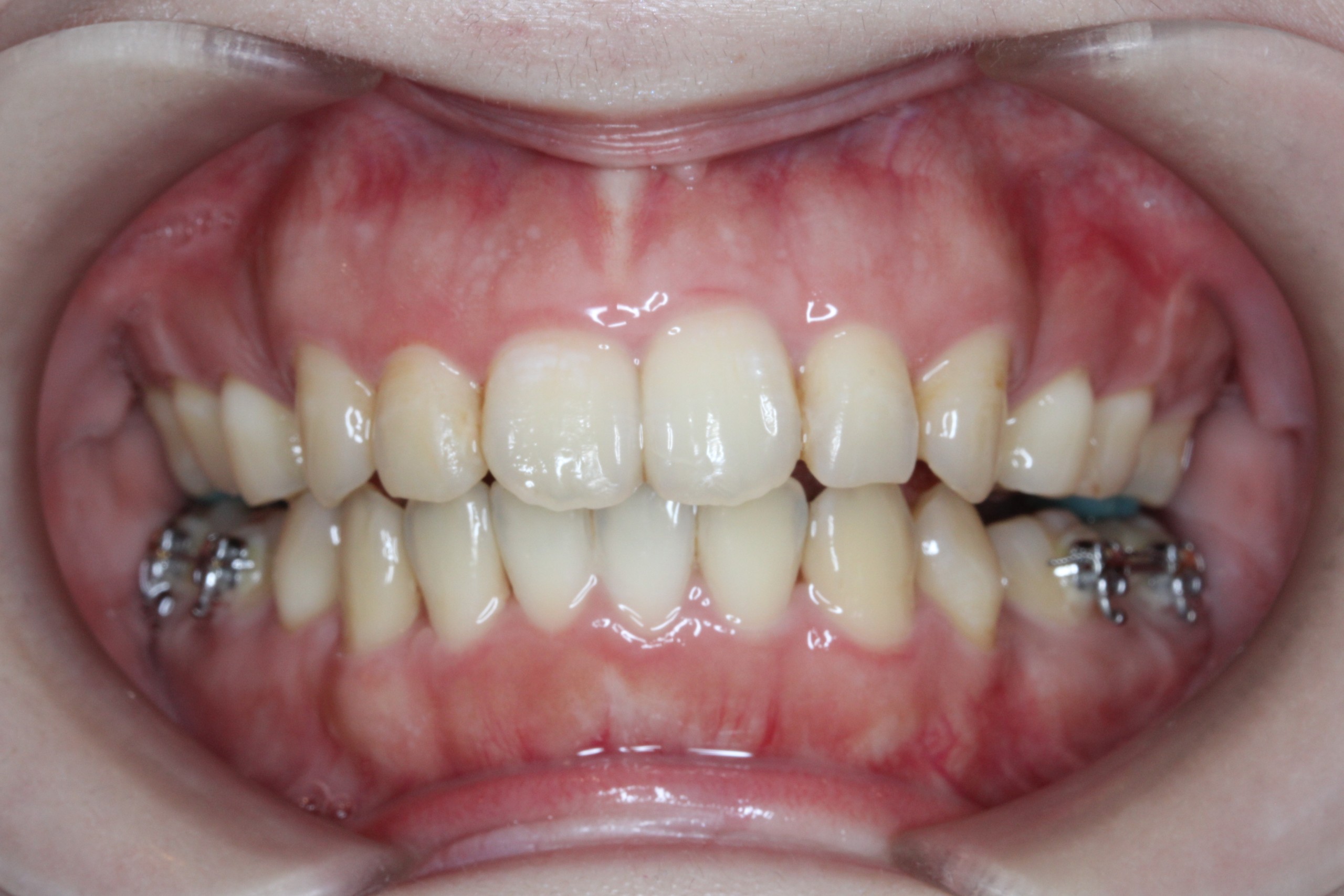 叢生・裏側矯正の症例