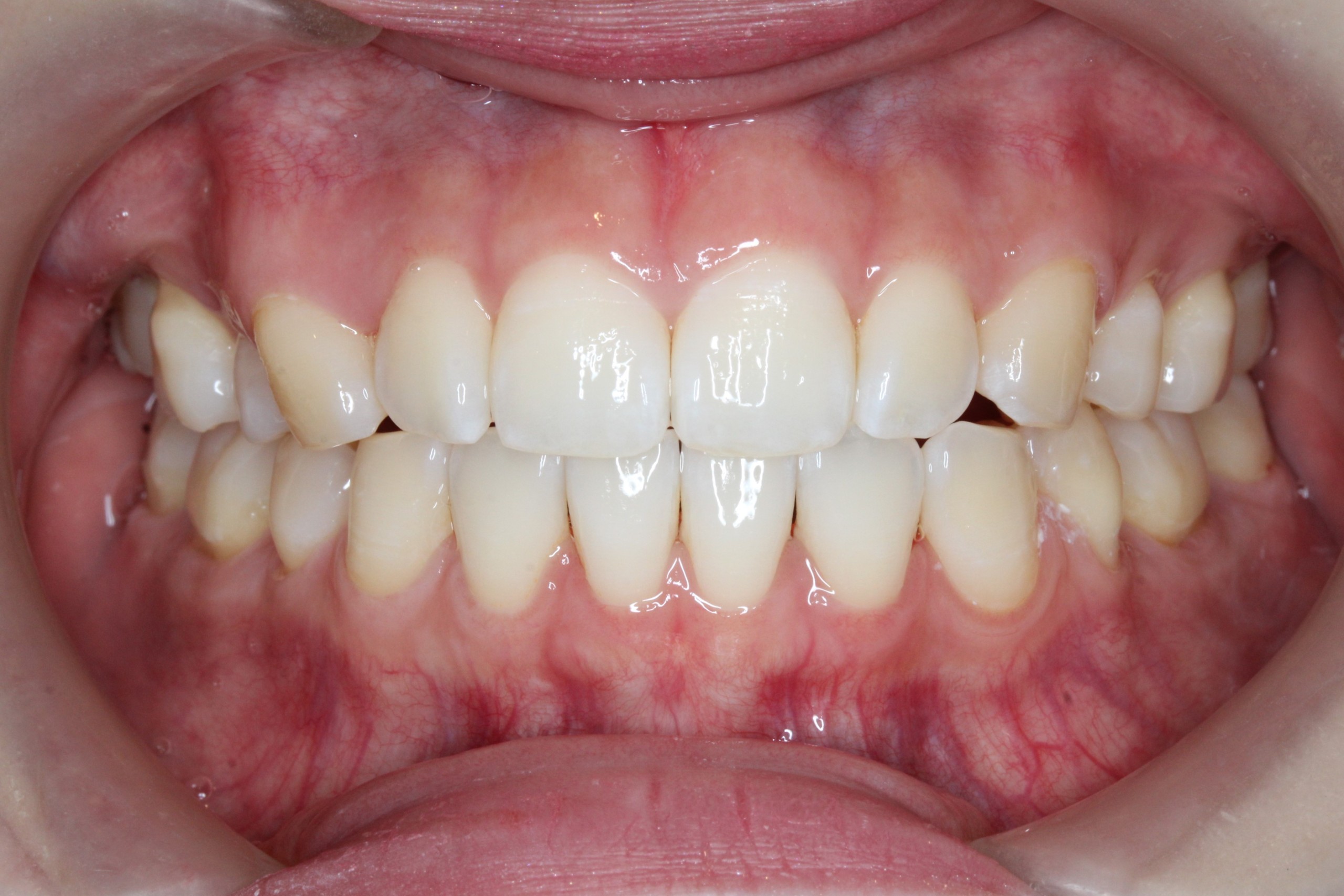 裏側矯正　上顎前突症例