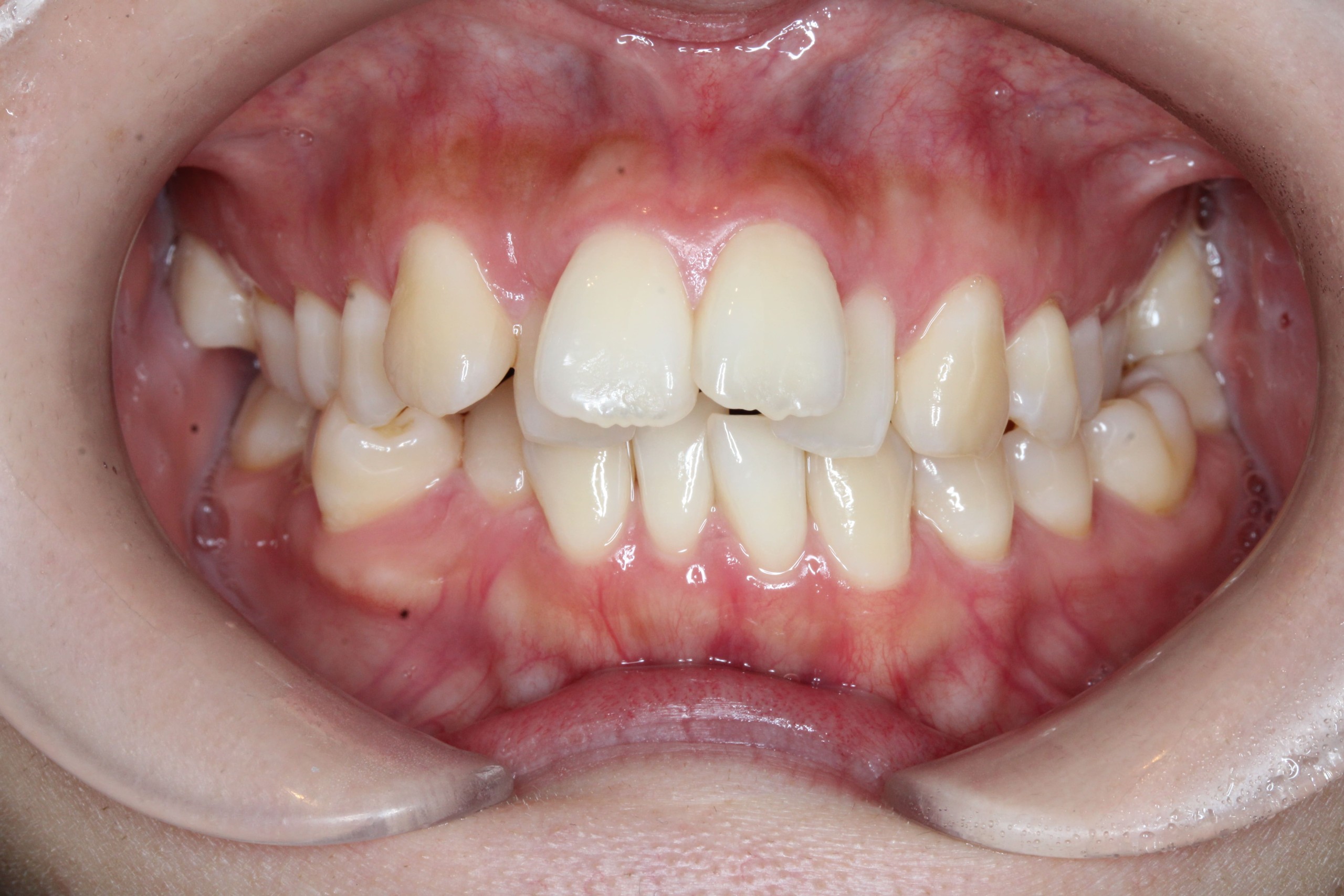 叢生・ハーフリンガルの症例