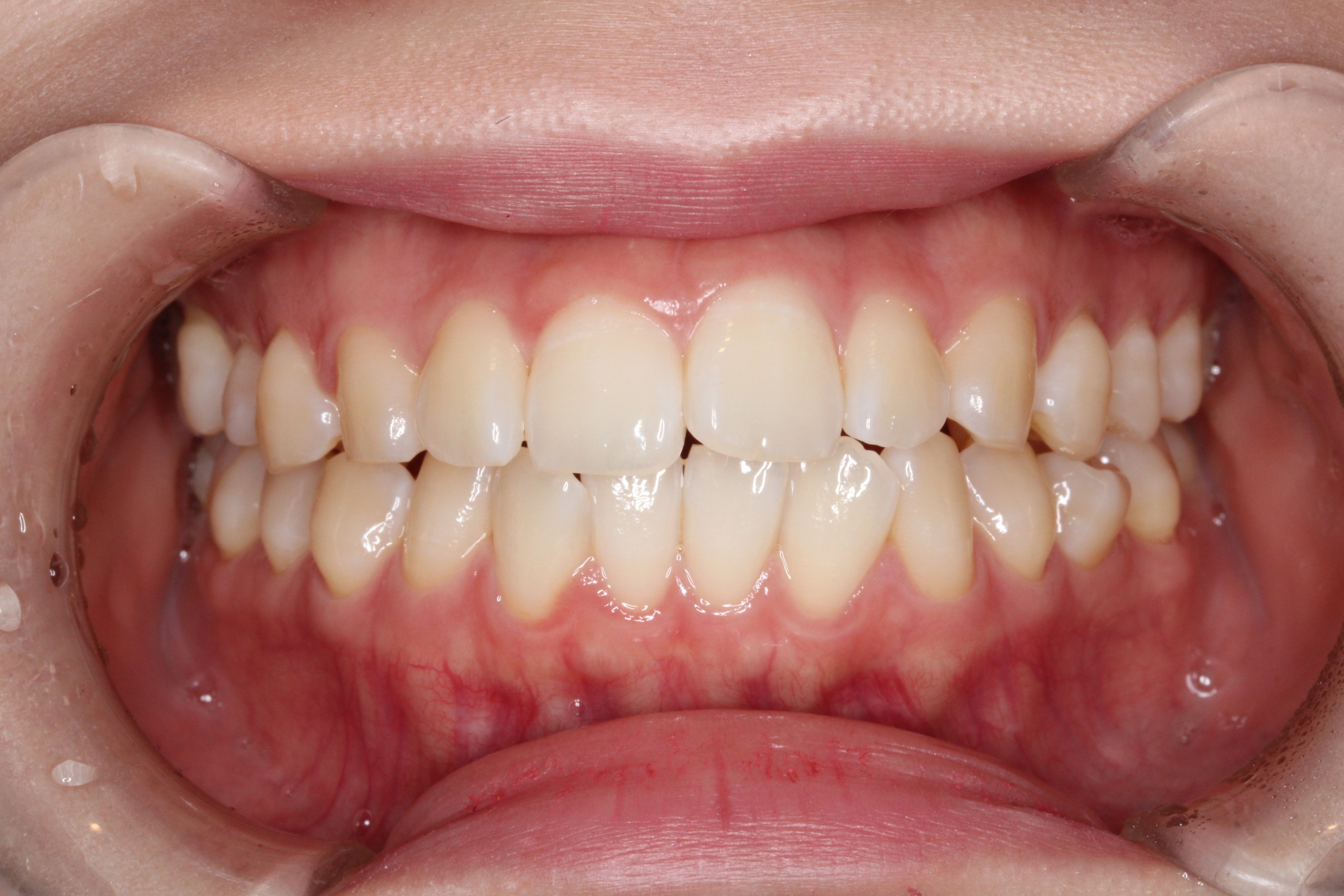 裏側矯正　上顎前突症例