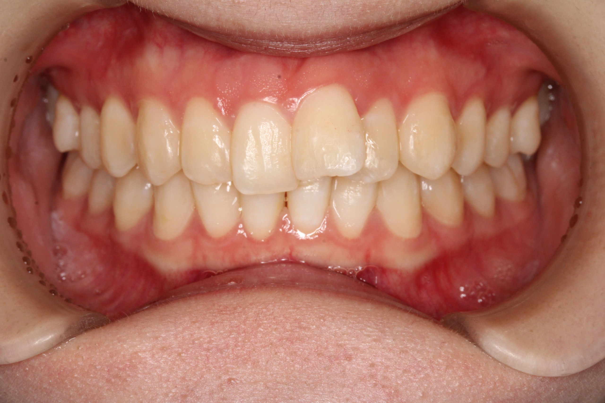 叢生・コンビネーション矯正の症例