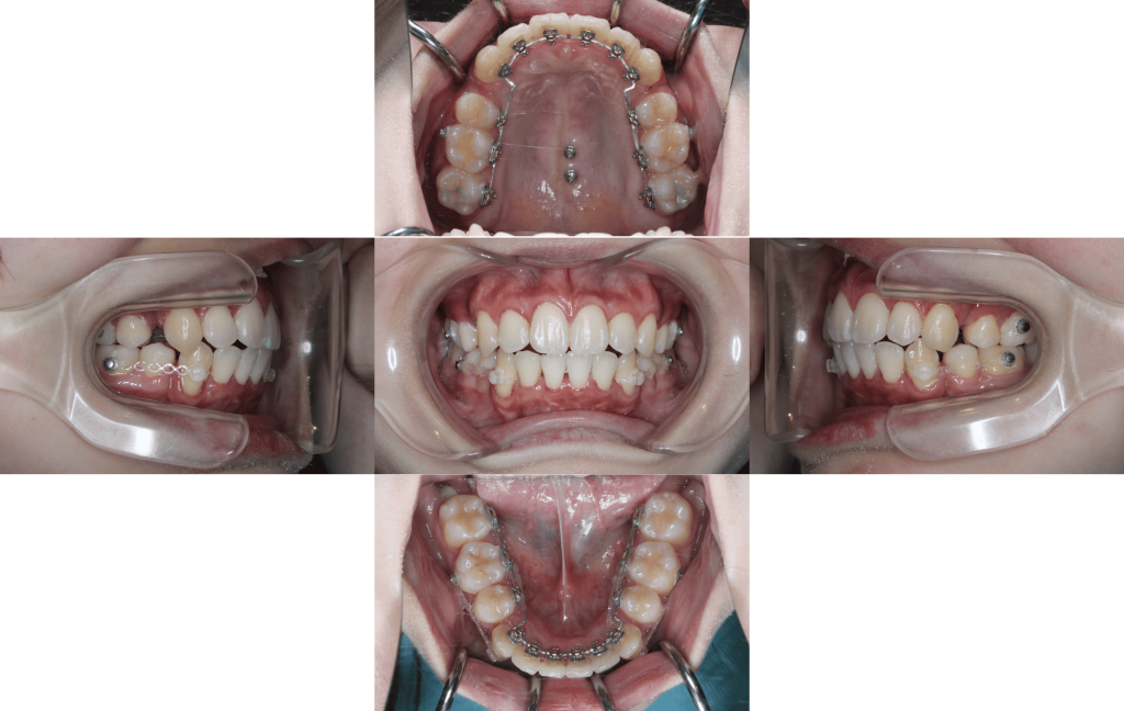 裏側矯正　上顎前突症例