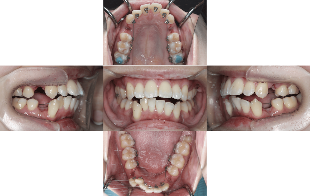 裏側矯正　上顎前突症例