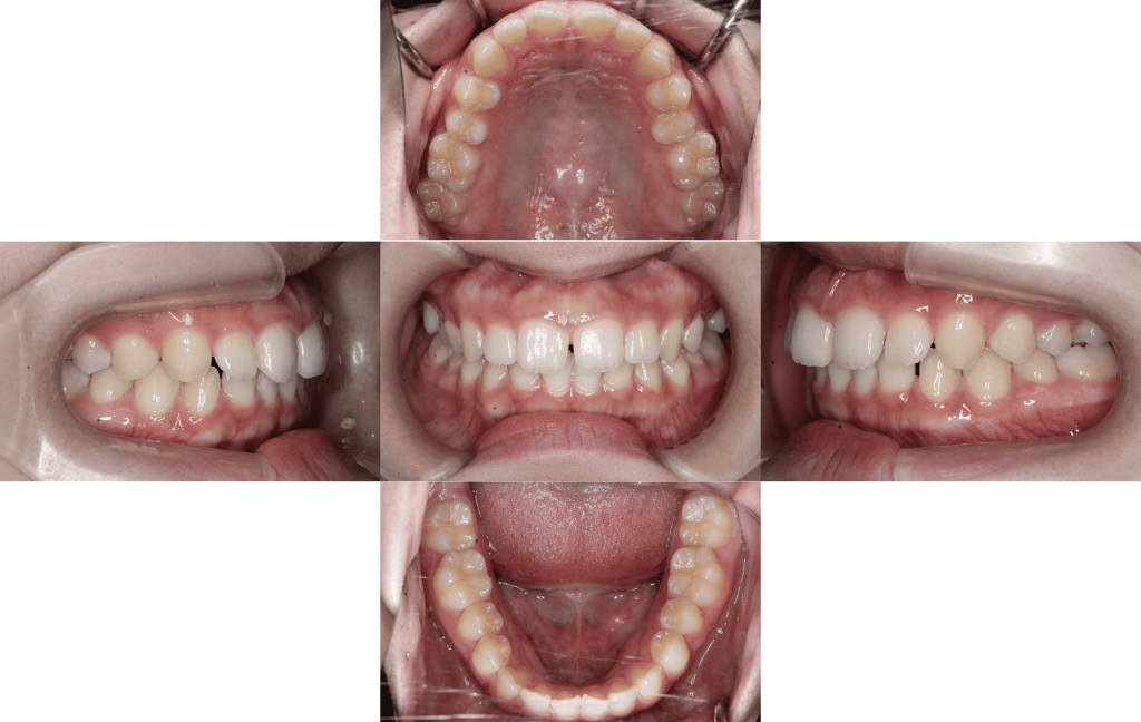 裏側矯正　正中離開症例