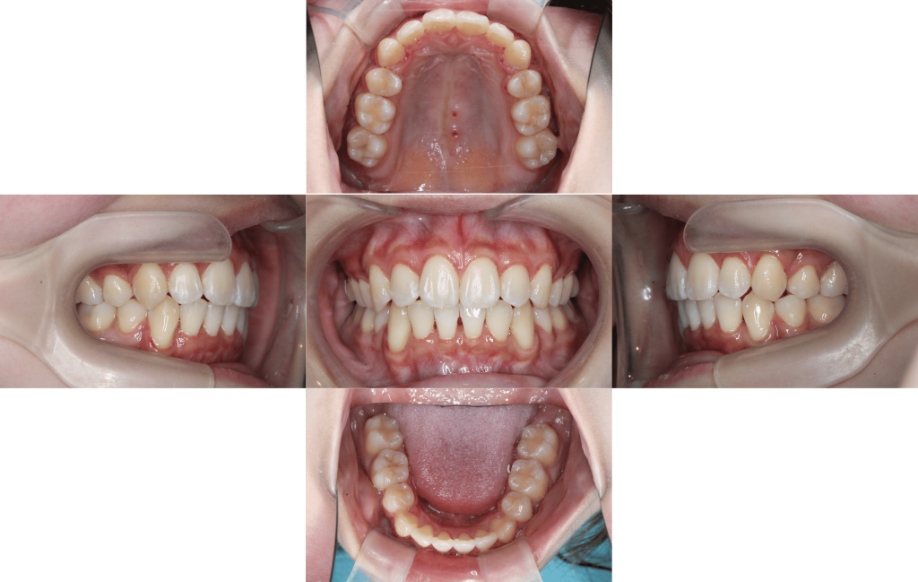 裏側矯正　上顎前突症例