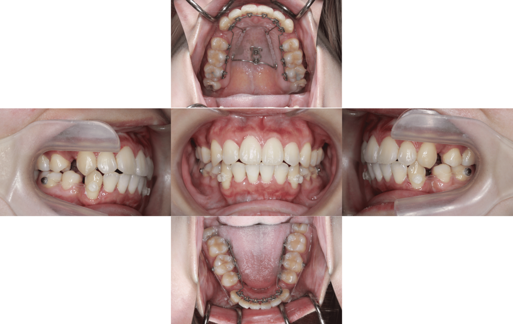 裏側矯正　上顎前突症例