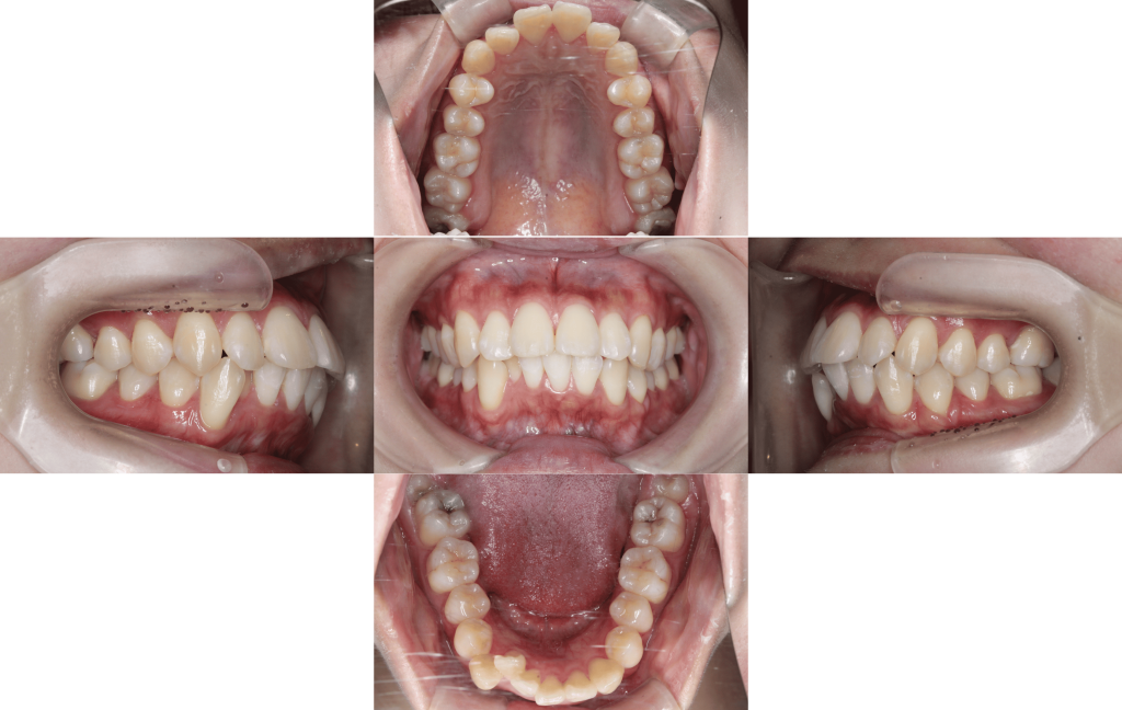 裏側矯正　上顎前突症例