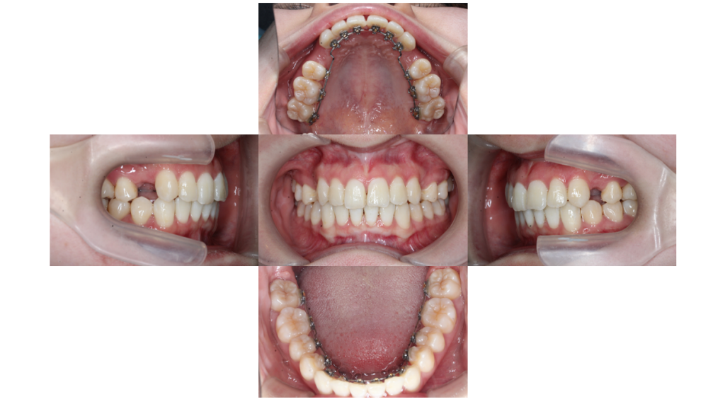 叢生・コンビネーション矯正の症例