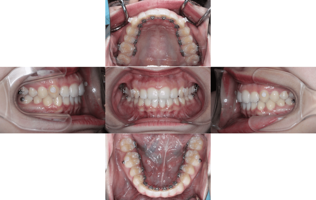 裏側矯正　正中離開症例