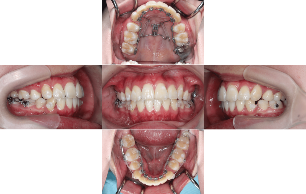裏側矯正　叢生症例