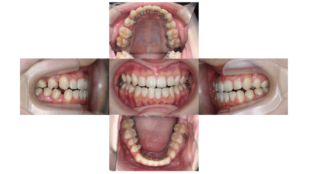 受け口・サージェリーファーストの症例