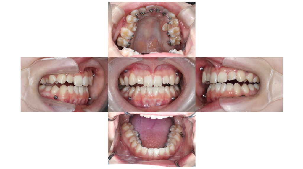受け口・サージェリーファーストの症例