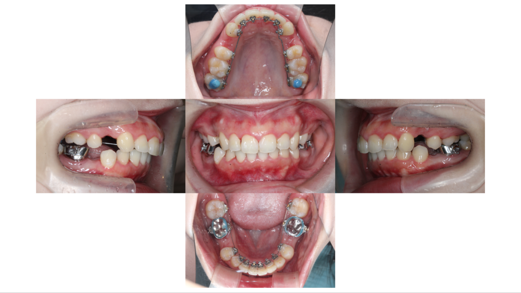 上顎前突・裏側矯正の症例