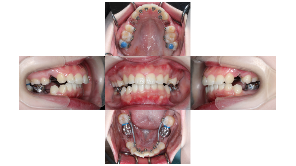 上顎前突・裏側矯正の症例