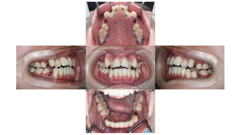 叢生・裏側矯正の症例