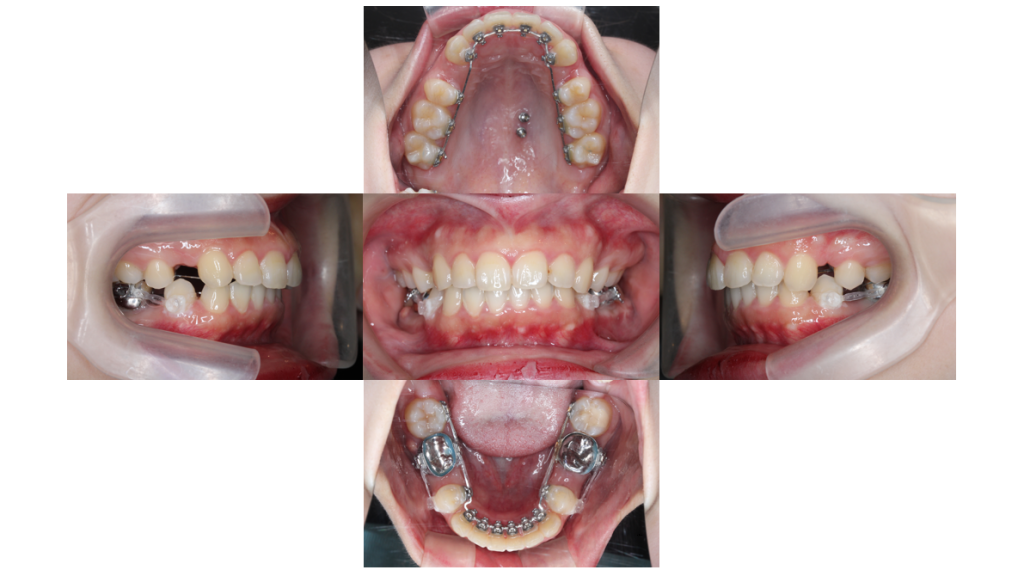 上顎前突・裏側矯正の症例