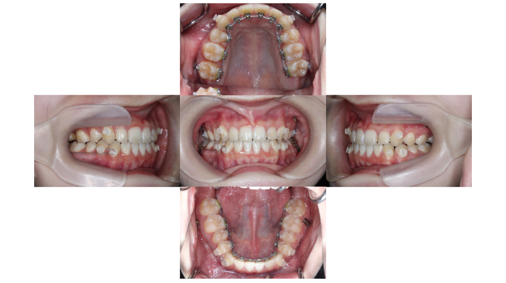 受け口・サージェリーファーストの症例