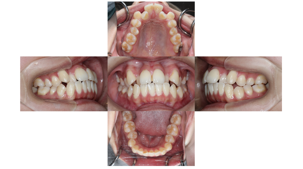 叢生・裏側矯正の症例
