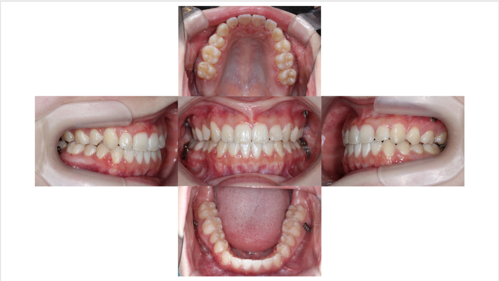 受け口・サージェリーファーストの症例