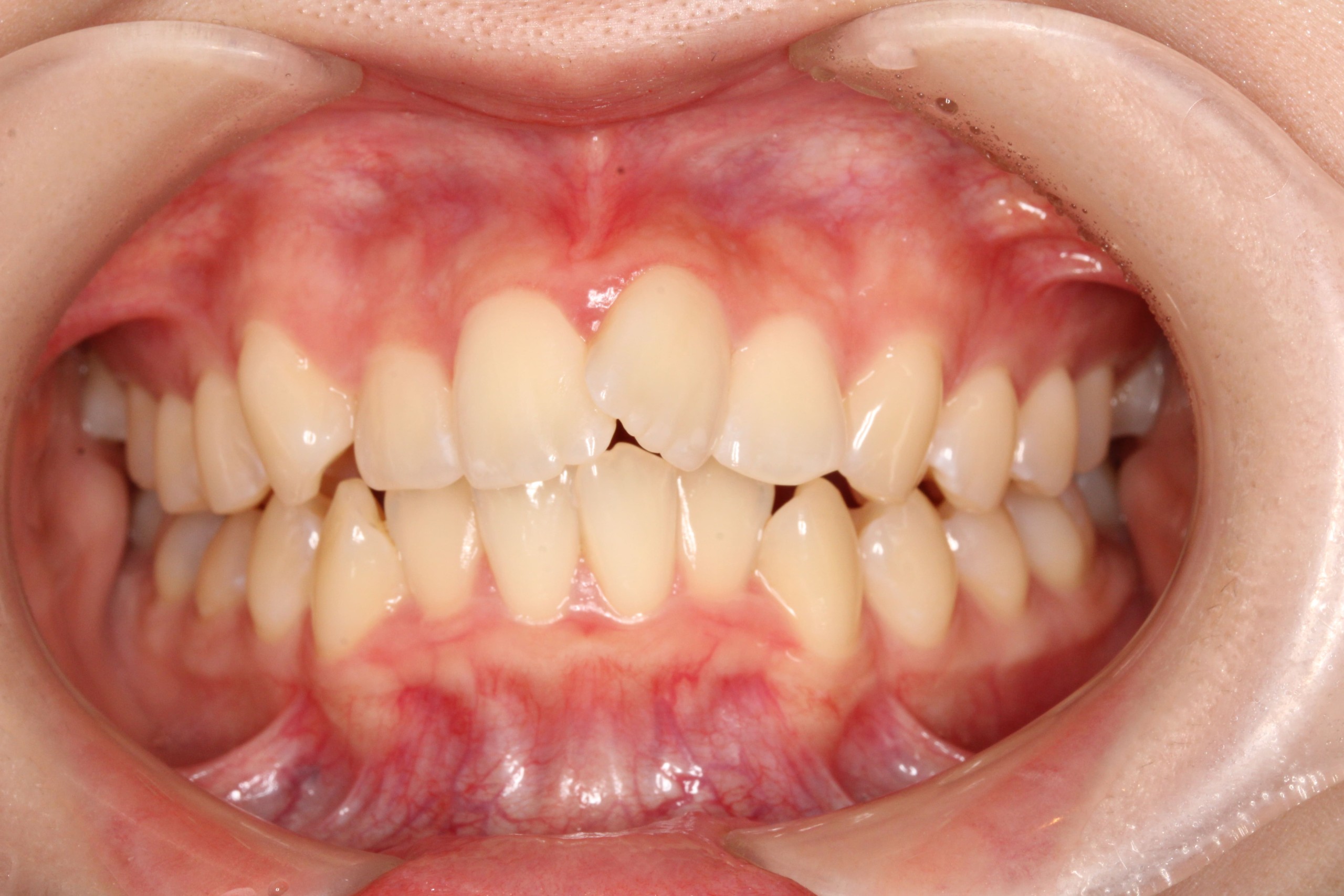 叢生・裏側矯正の症例