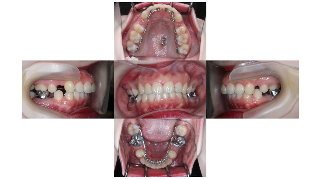 上顎前突・裏側矯正の症例
