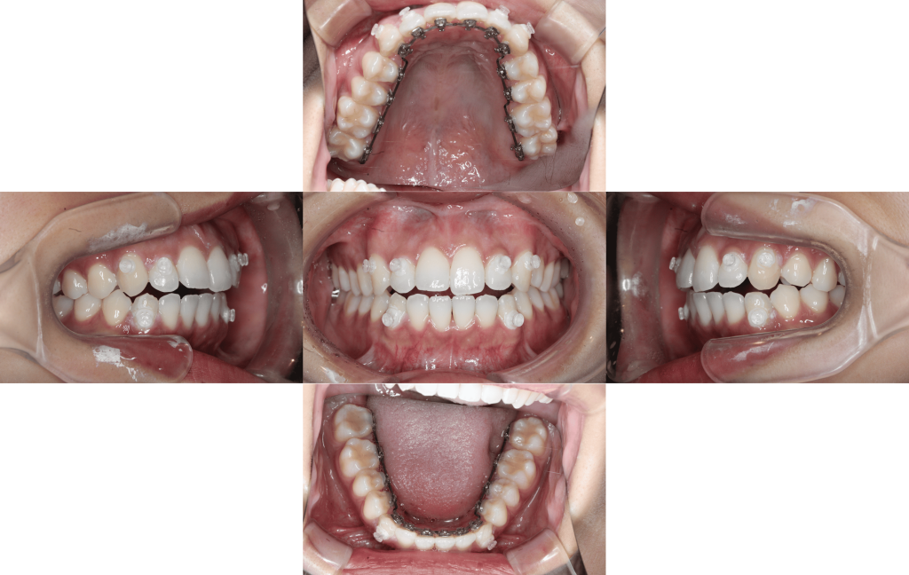 裏側矯正　叢生症例