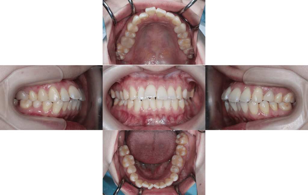 裏側矯正　叢生上顎前突症例