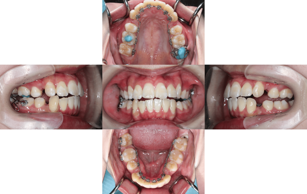 裏側矯正　叢生症例