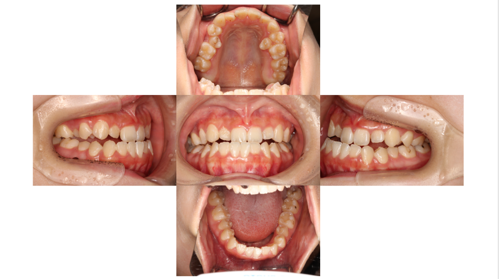 受け口・サージェリーファーストの症例