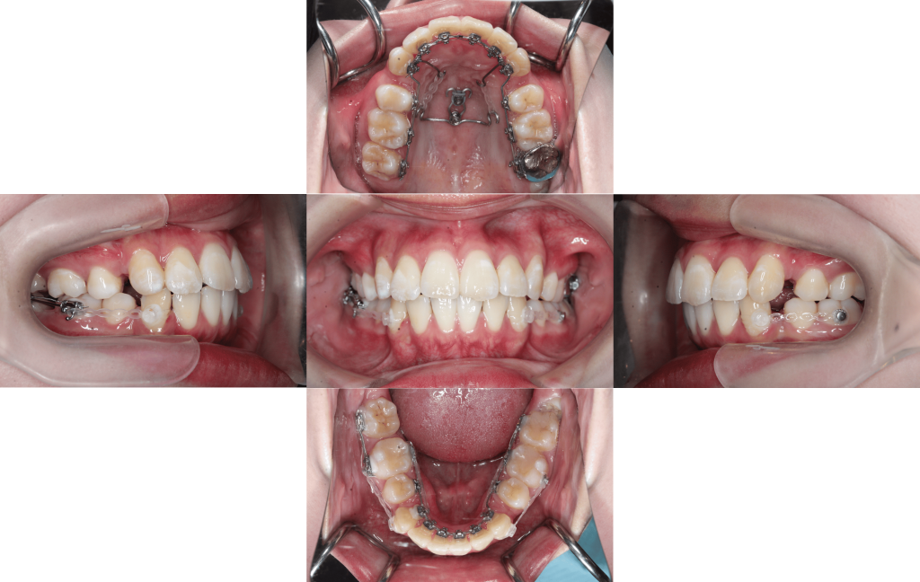 裏側矯正　叢生症例