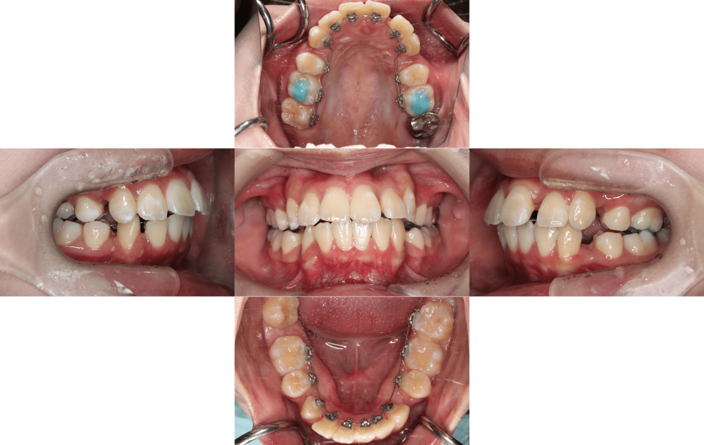 裏側矯正　叢生症例