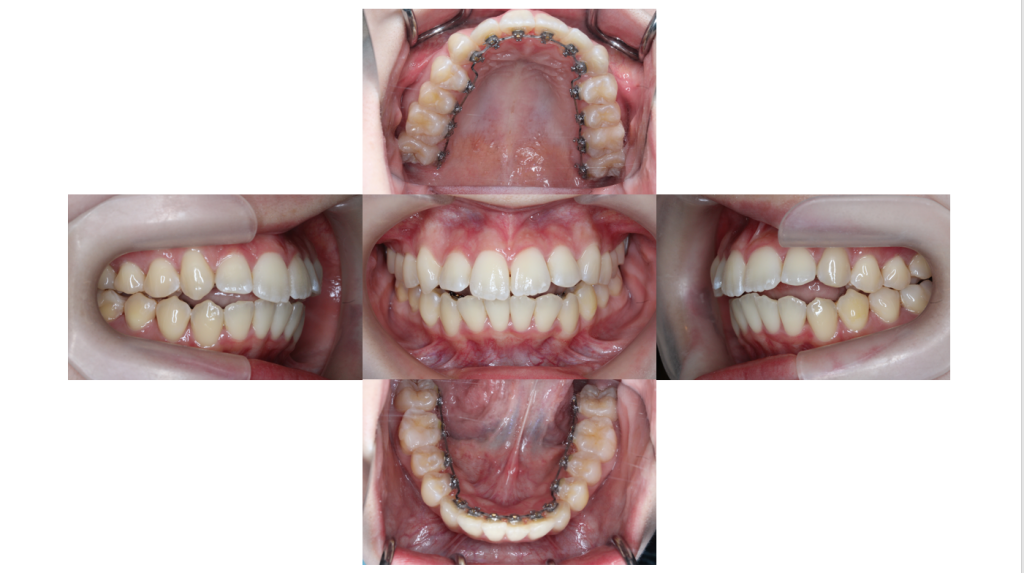 叢生・裏側矯正の症例