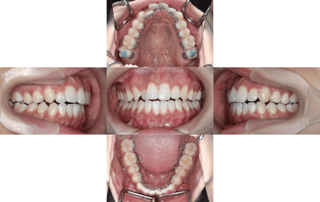 裏側矯正　叢生症例