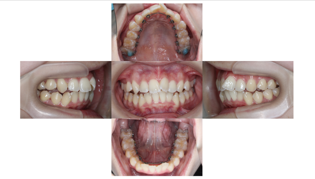 叢生・裏側矯正の症例