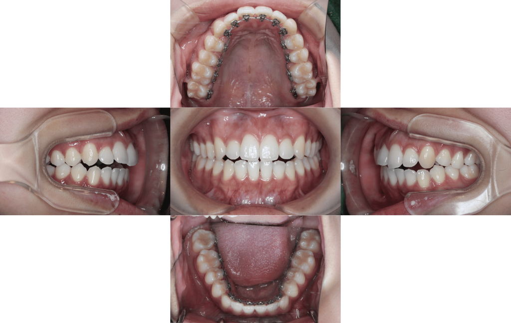 裏側矯正　叢生症例