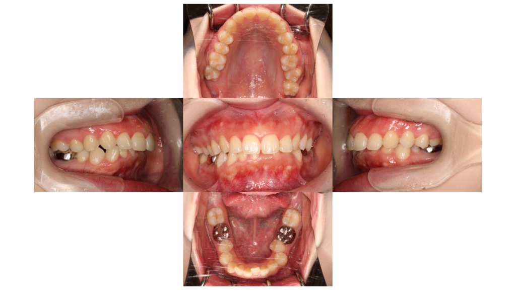 上顎前突・裏側矯正の症例