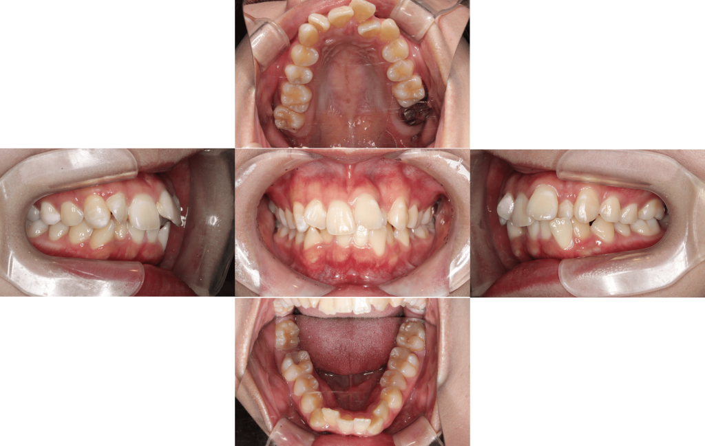 裏側矯正　叢生症例