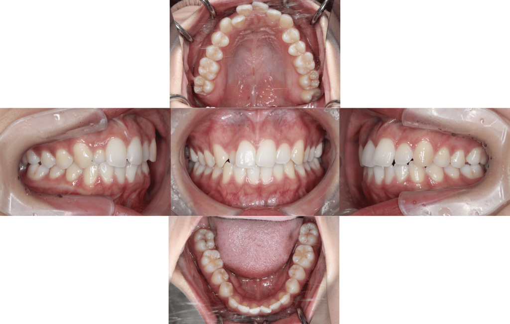 裏側矯正　叢生症例